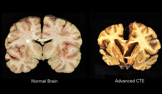 Chronic Traumatic Encephelopathy